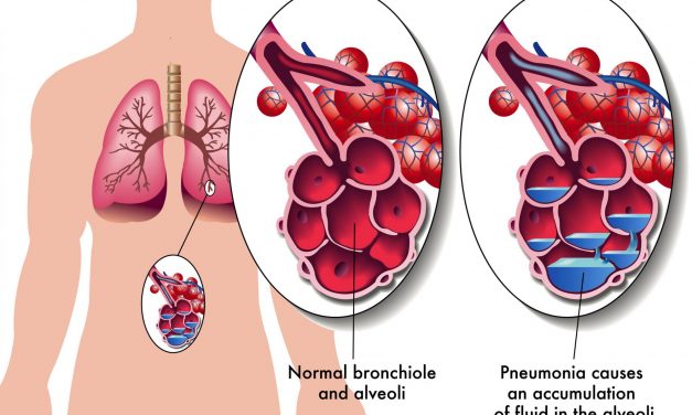 Pneumonie aiguë ou infection pulmonaire : symptômes, contagion et traitement